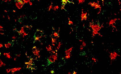 The NLRP3 inflammasome (green) is expressed by immune cells (red) in the brains of people with Parkinson’s disease.
